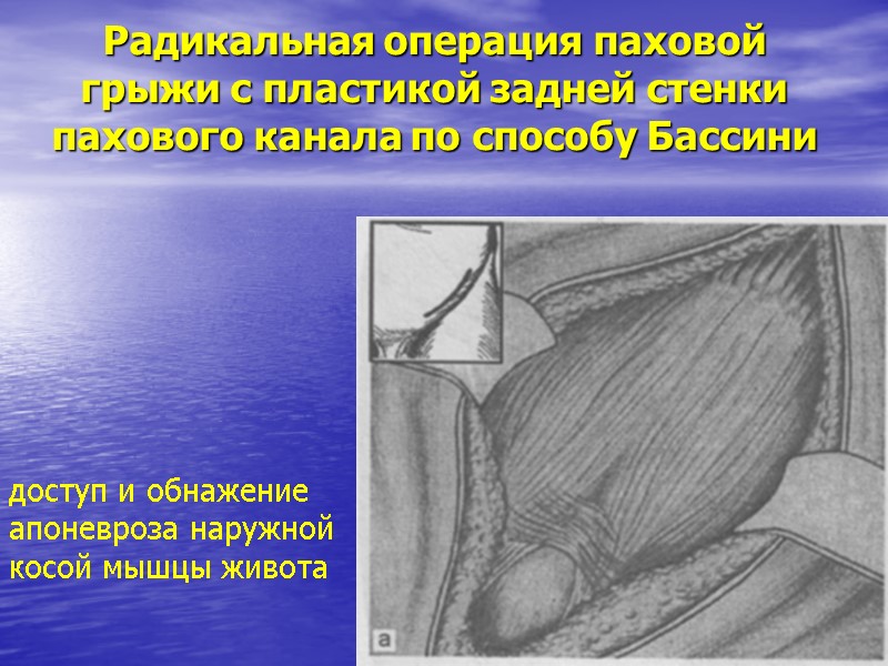 Радикальная операция паховой грыжи с пластикой задней стенки пахового канала по способу Бассини 